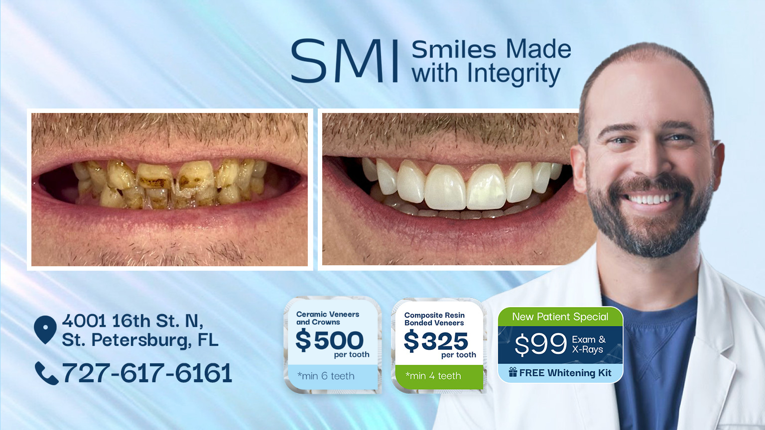 Cosmetic Dentistry Ceramic Veneers and Crowns Special in St.Pete Cosmetic Dentistry Ceramic Veneers and Crowns Special in St.Pete